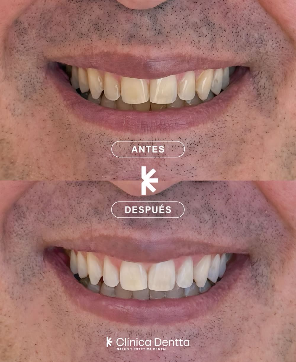 Antes y después de un blanqueamiento dental en Clínica Dentta, Candelaria: dientes más claros con un resultado natural