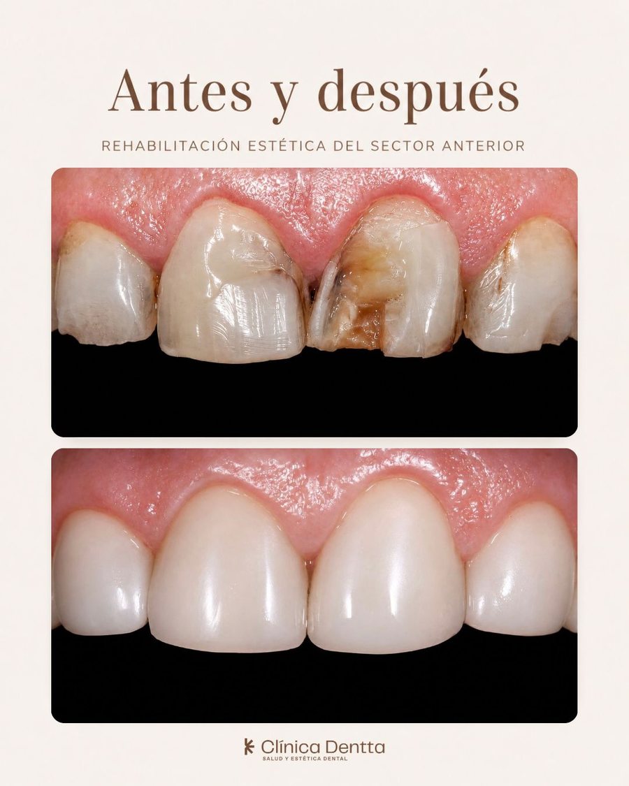 Antes y después de una rehabilitación estética con carillas en el sector anterior, en Clínica Dentta, Candelaria: dientes fracturados y oscurecidos que quedan con una sonrisa natural