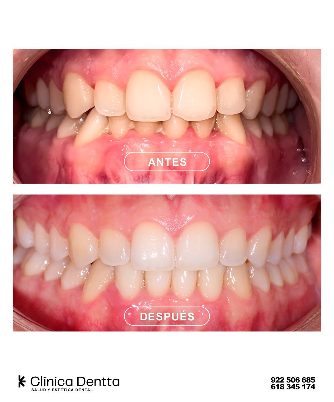 Antes y después de un tratamiento de ortodoncia invisible en Clínica Dentta, Candelaria: dientes apiñados que quedan alineados